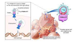 Lutetium-177 PSMA therapy