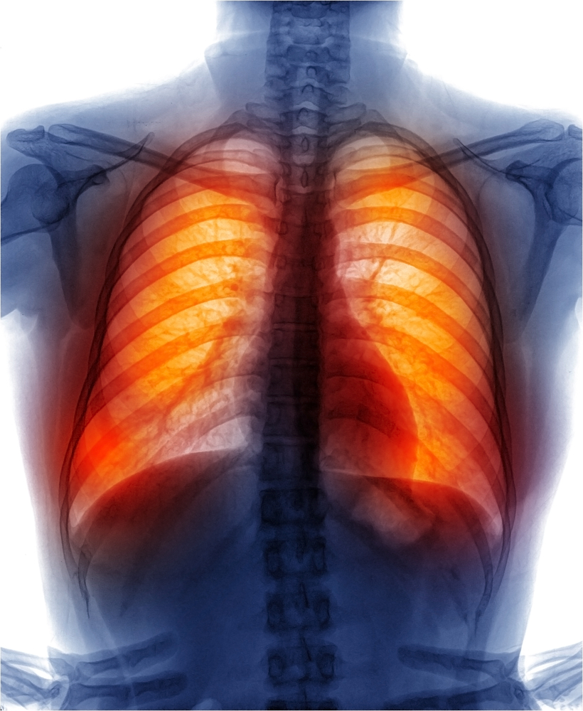 saddle-pulmonary-embolism