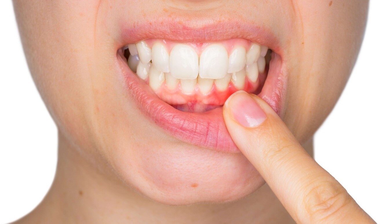 Gum Disease Treatment