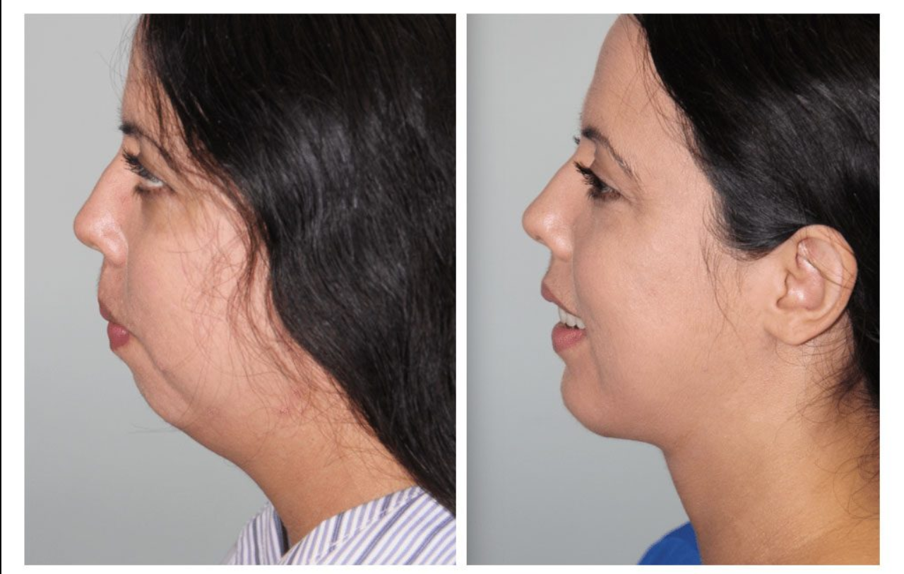 chin augmentation