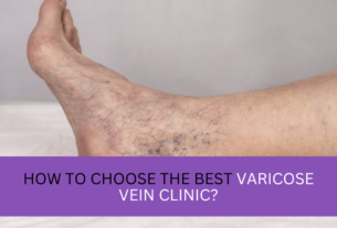 How To Choose The Best Varicose Vein Clinic?