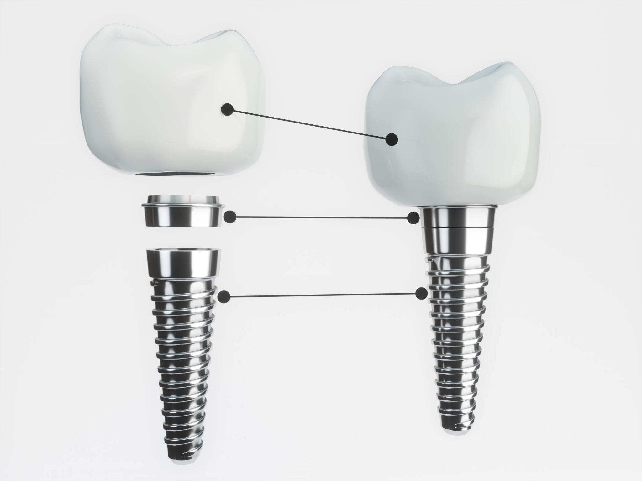 dental implants