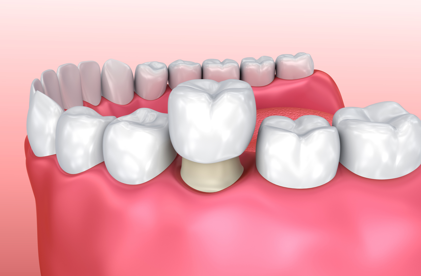 Dental Crowns in Flagstaff