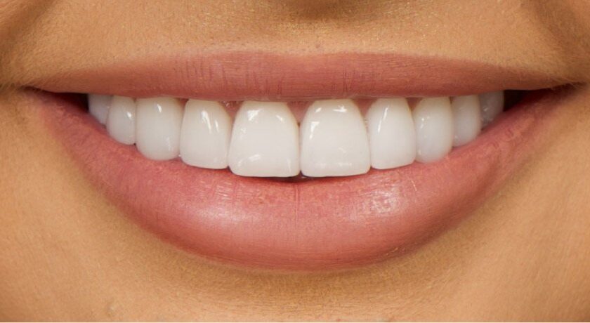 Dental Veneers in Glendale