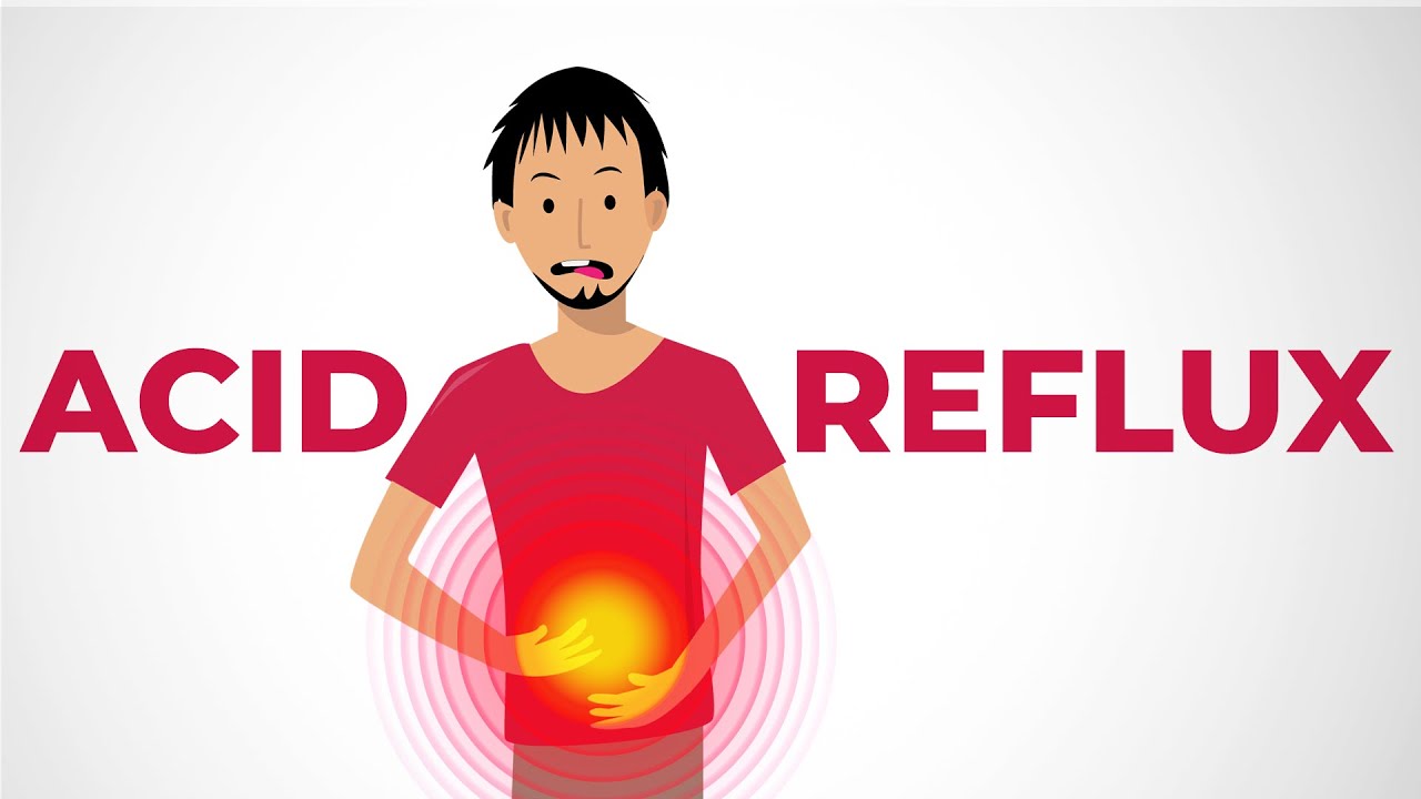 How Aciloc 150mg Alleviates Acid Reflux and Heartburn