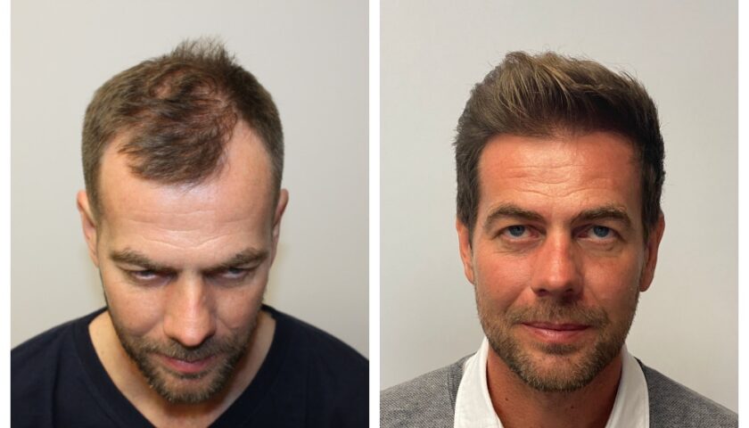 Top-Rated Hair Transplant Surgeons in London: Finding the Right Clinic for You