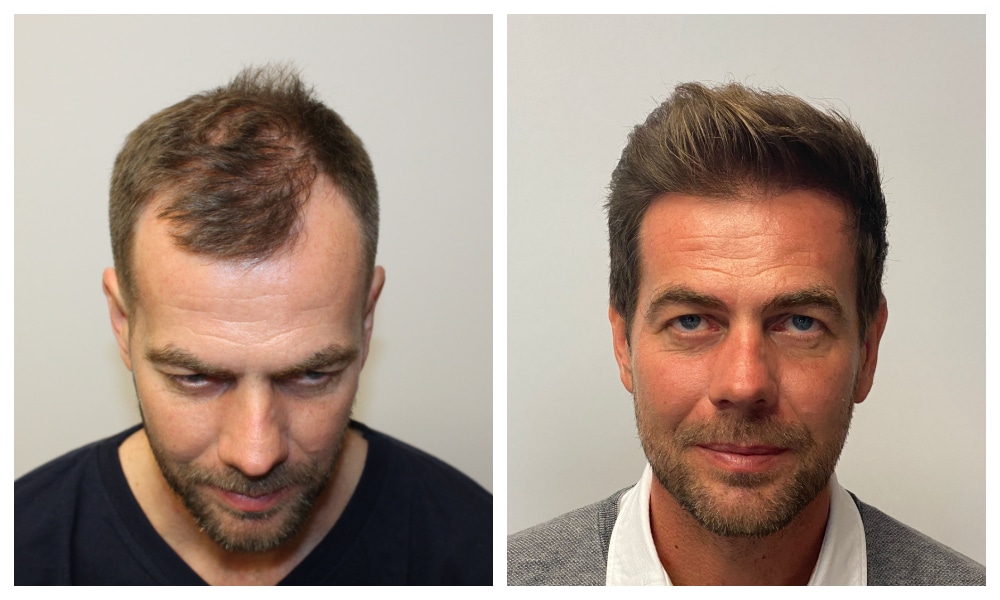 Top-Rated Hair Transplant Surgeons in London: Finding the Right Clinic for You