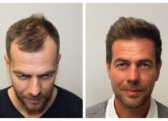 Everything You Need to Know About FUE Hair Transplant in the UK: Costs, Clinics, and What to Expect in London