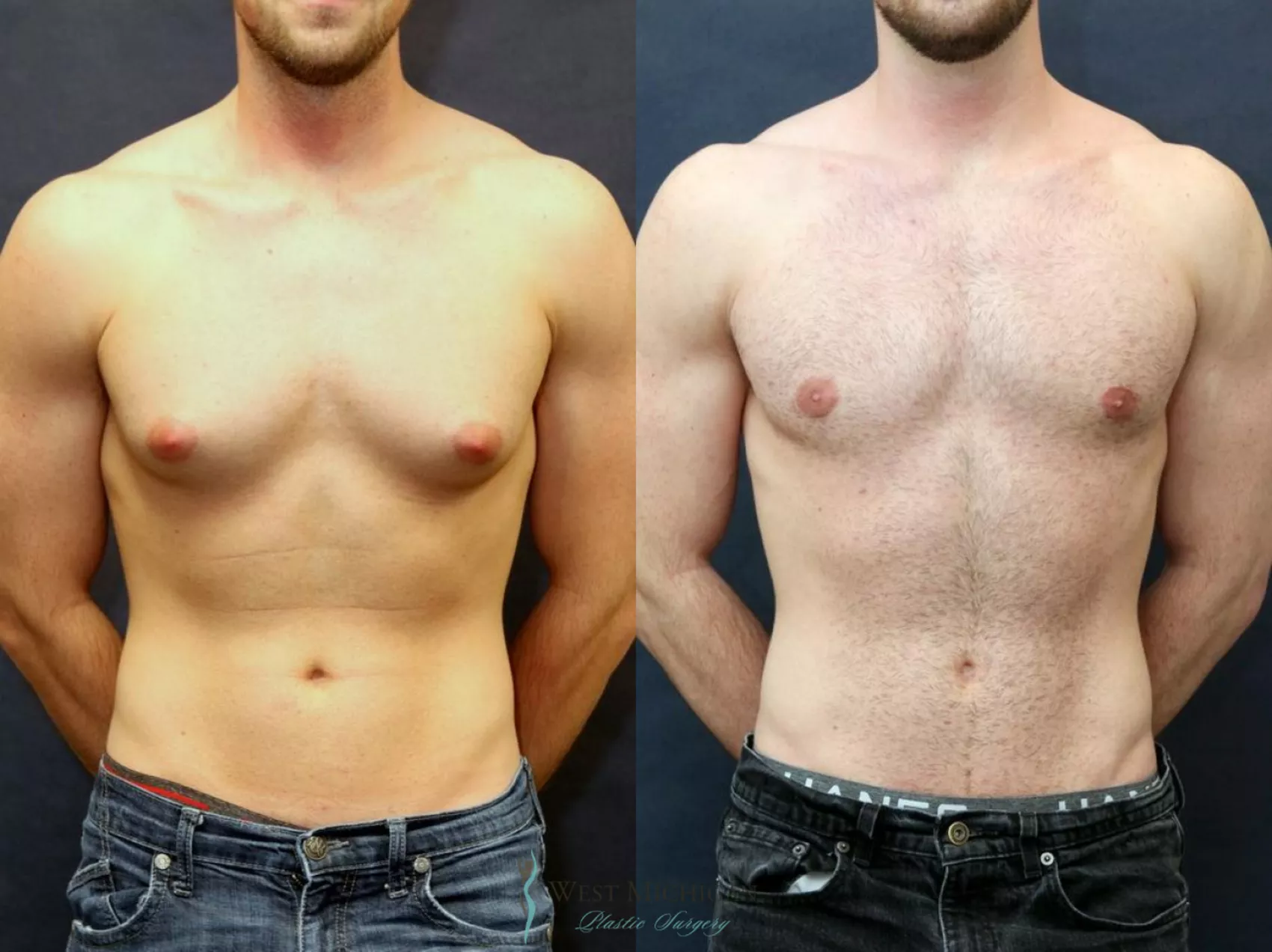 Gynecomastia Surgery in Dubai