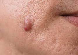 Effective Skin Tag Removal in London: Trusted Clinics and Treatment