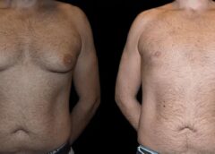 gynecomastia in dubai