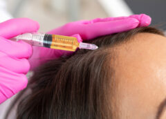 PRP Hair Treatment in London: A Revolutionary Solution for Hair Restoration