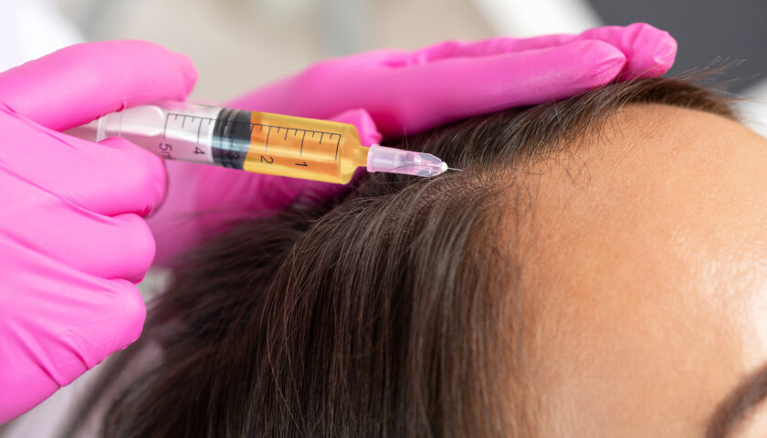 PRP Hair Treatment in London: A Revolutionary Solution for Hair Restoration