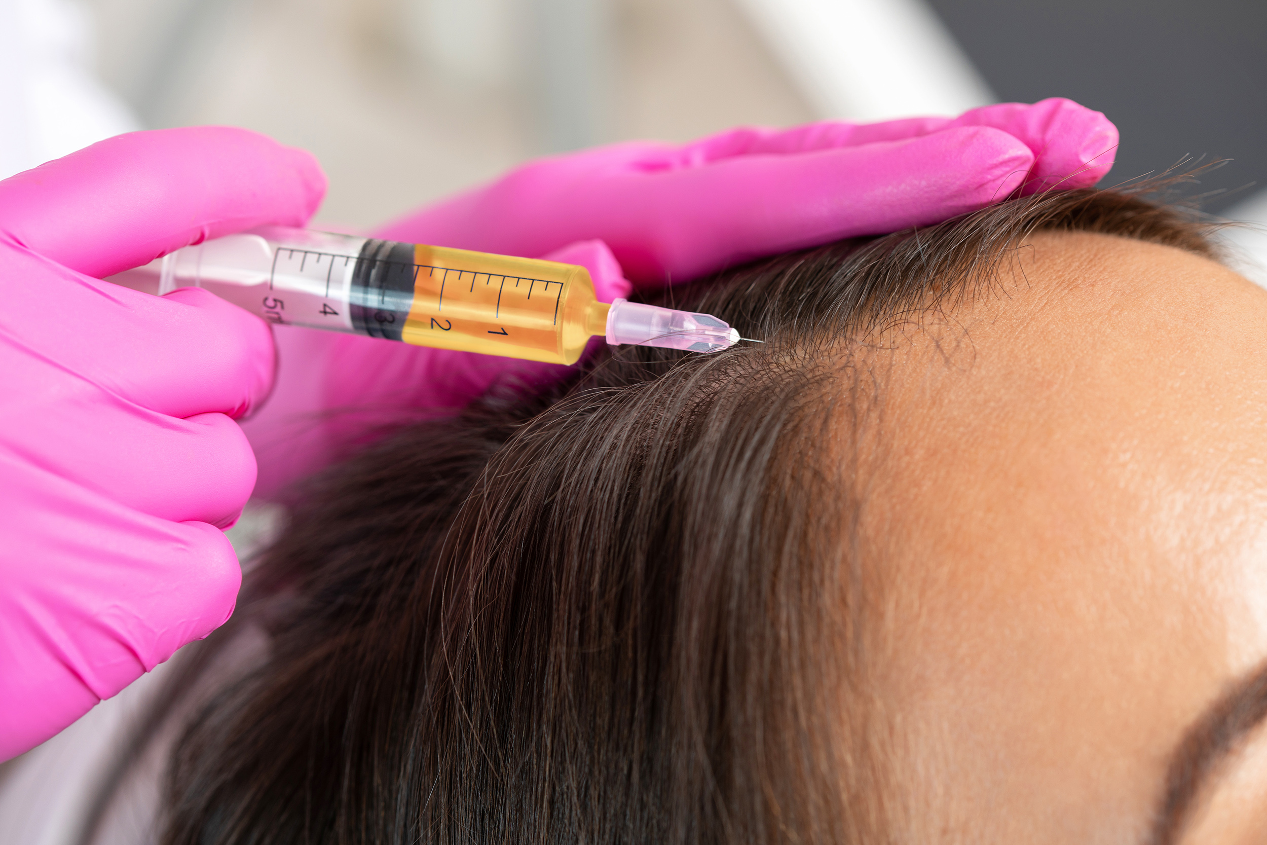 PRP Hair Treatment in London: A Revolutionary Solution for Hair Restoration