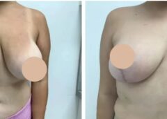 breast lift in dubai