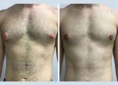 Best Doctors in Dubai for Gynecomastia