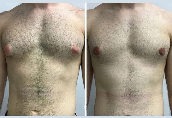 Best Doctors in Dubai for Gynecomastia