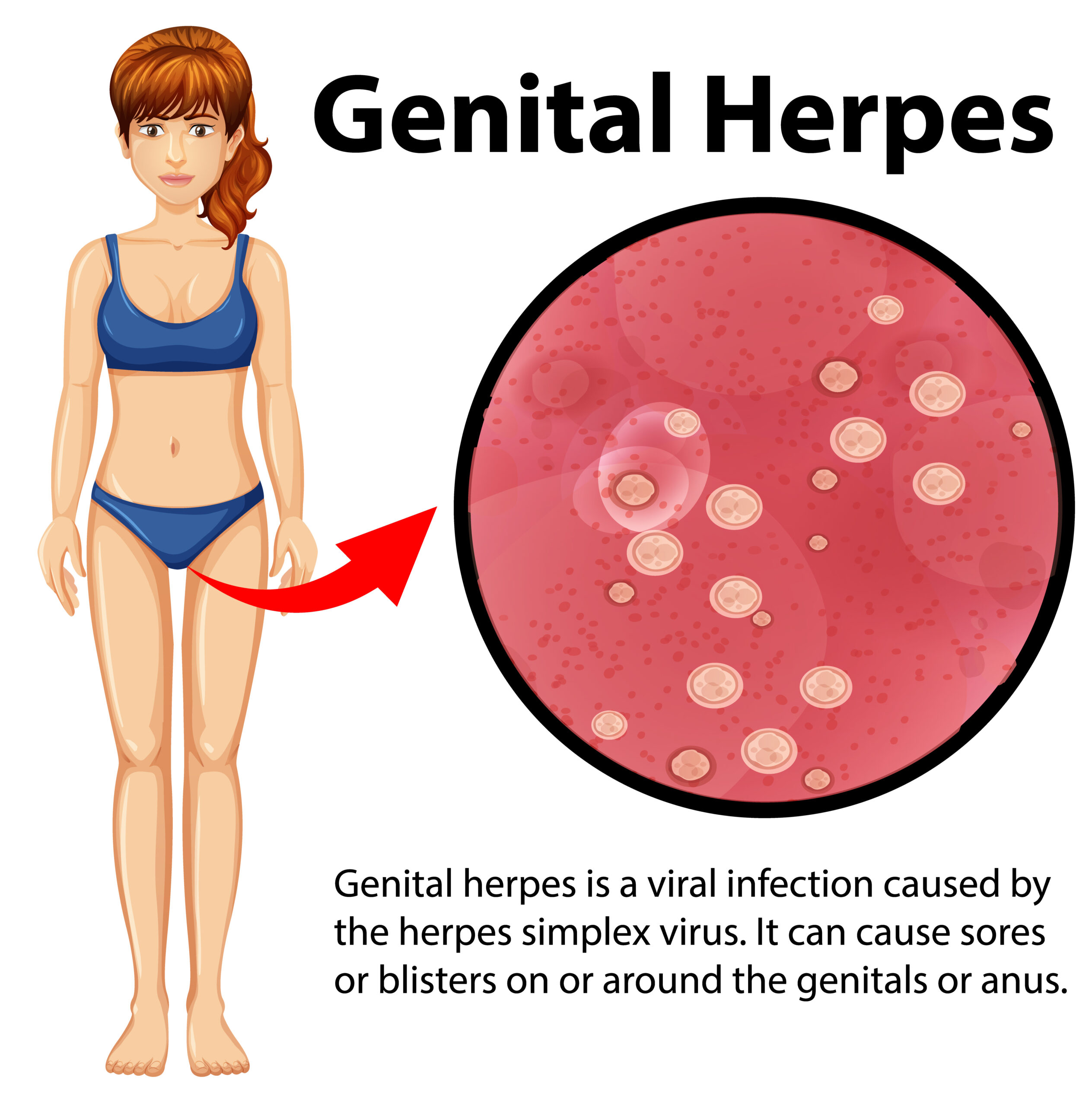 Genital Herpes