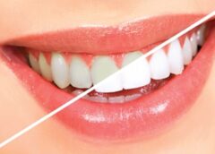 teeth whitening Manhattan